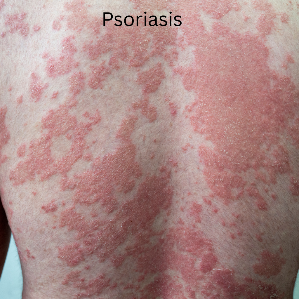Psoriasis