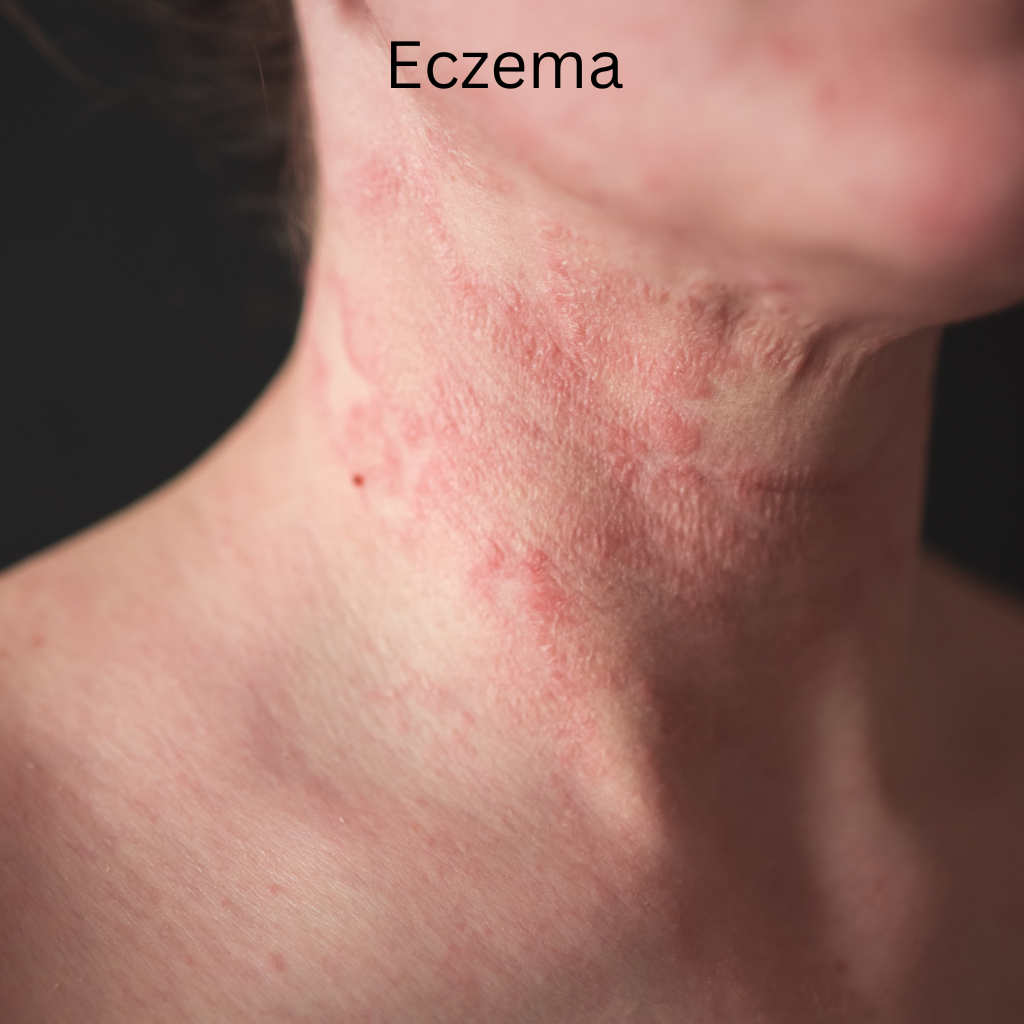 Eczema